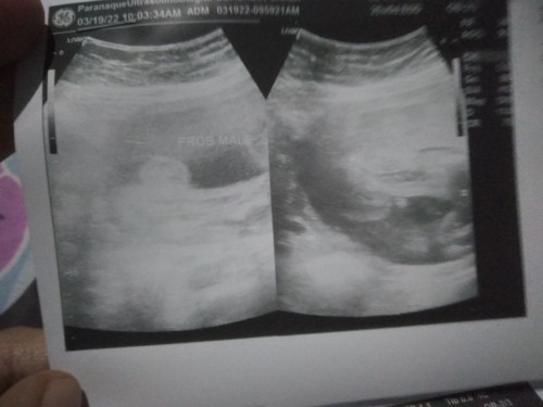Boy po ba yung nasa ultrasound ko?