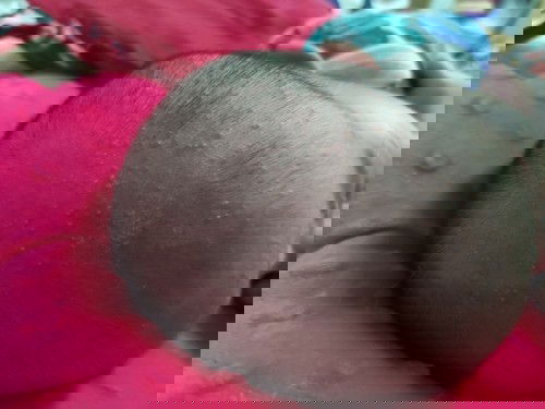 Bintik merah pada kulit kepala dan muka