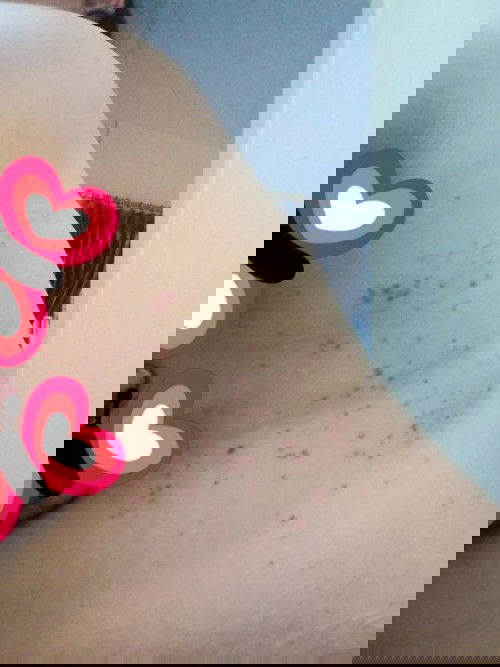 สอบถามแม่ๆนะคะ เรามีผื่นขึ้นตามหลังและไหล่