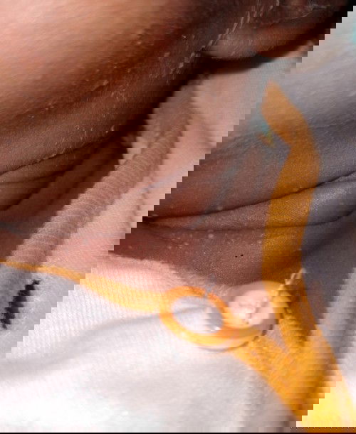 Bintik bintik pada bayi