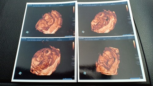 เคลียดหรือร้องไห้เยอะๆ