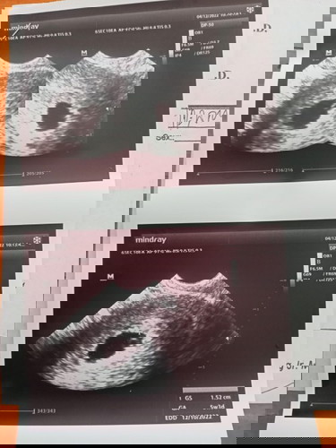 Ano pong tawag dun sa bilog sa loob ng gestational.sac