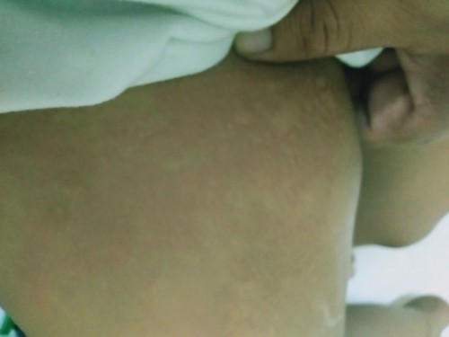 ขึินผื่นนูนๆ