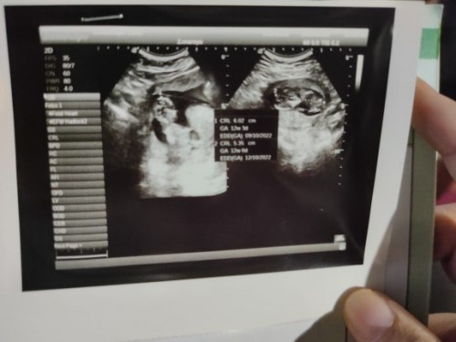 saya baru pertama hamil semenjak 1,5tahun menikah,dan pas di usg saya kembar,minta tips nya dong mom