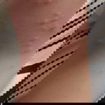 Bentol Di Kaki dan Jari Tangan