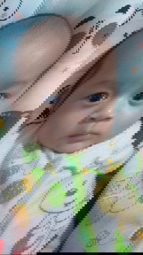 Lipatan Mata Tidak Ada