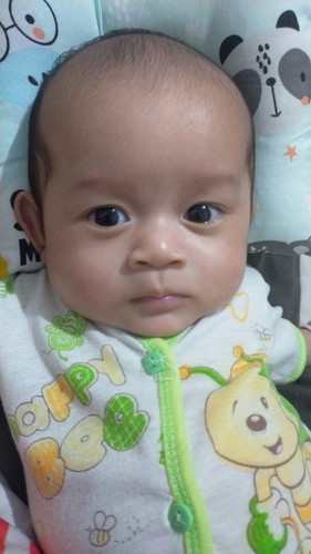 Lipatan Mata Tidak Ada