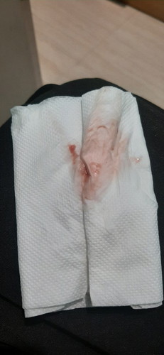 Possible Bleeding