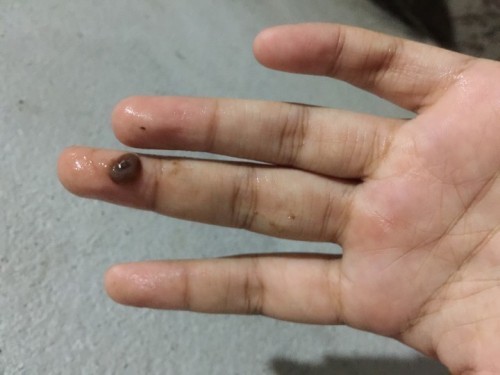 เลือดสีน้ำตาลเข้มไหลออกทางช่องคลอด