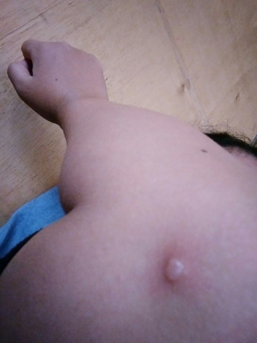 Cacar pada ibu hamil trimester 3 usia kandungan 32 minggu