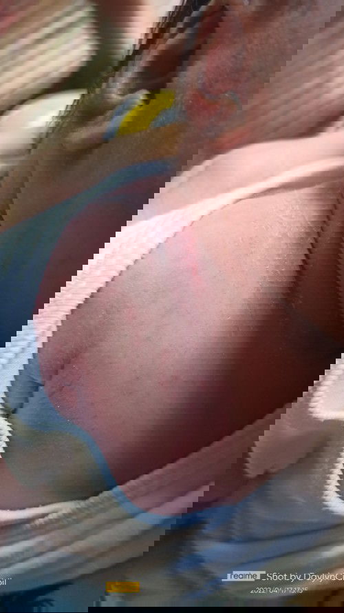 RASHES NI BABY SA KATAWAN AT MUKHA, ANO PEDE MAIGAMOT MGA MOMSH?