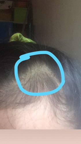 PostPartum Hairloss