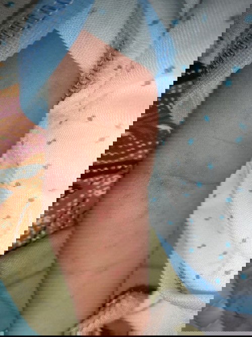 kulit kemerahan pada bayi