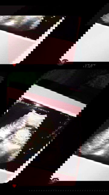 usg 4 bulan apakah sudah akurat