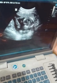 Mohon penjelasannya ya bund soal nya baru hamil