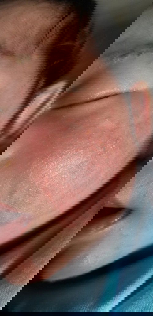 rashes sa face ni baby