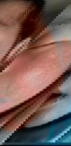 rashes sa face ni baby