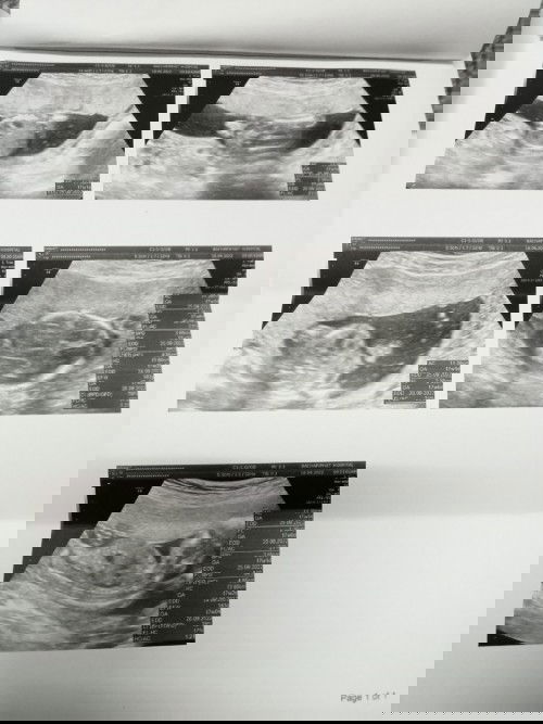 พอจะมีแม่ๆบ้านไหนมองน้องออกมั้ยค่ะ18w4d