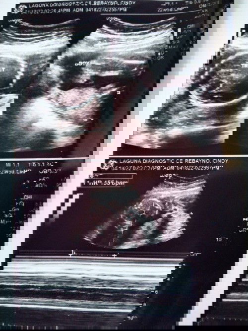Ultrasound