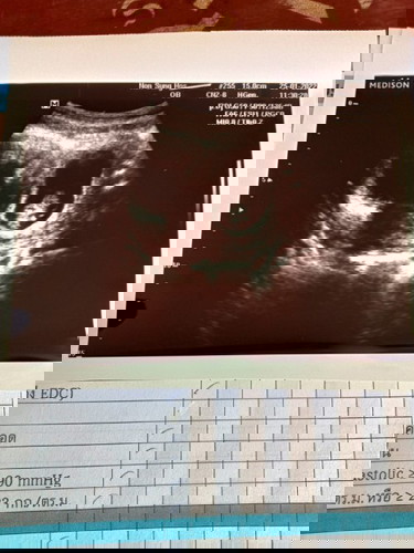 แบบนี้มีโอกาศเป็นลูกแฝดมัยค่ะ