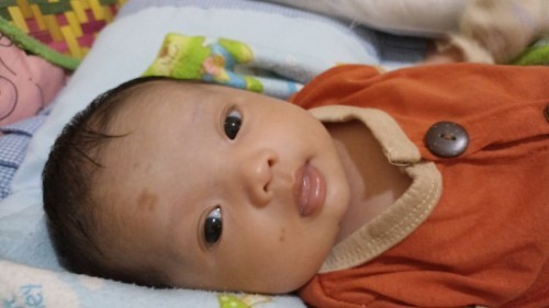 Noda flek coklat pada bayi