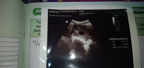 kawatir di USG UK mundur