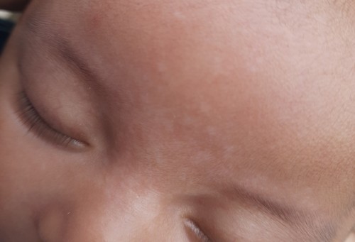 Menghilangkan putih putih di wajah bayi