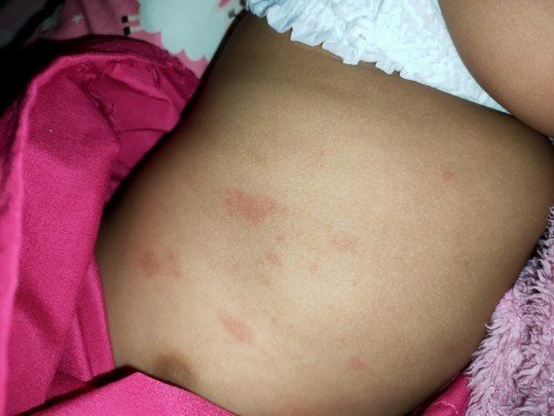 น้องเป็นผื่นแบบนี้ มีอาเจียนด้วยบางครั้ง ใช่มาจากอาการแพ้นมวัวไหมค้ะ