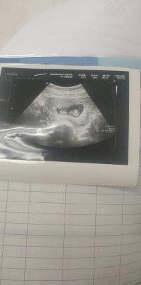 แพ้ท้อง☺️😊