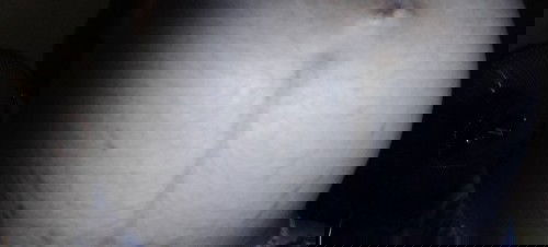 แตกลายที่ท้องกับที่ขา