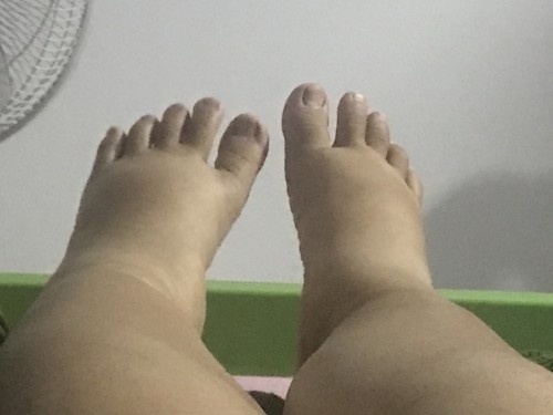 บวมหนักมาก ยังกะจะระเบิด
