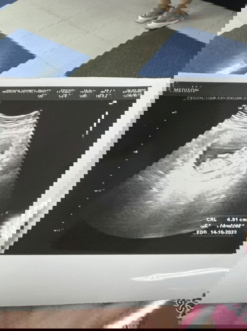 สอบถามแม่ๆ อายุ 30 ปีตรวจคัดกรองเด็กดาวน์กันมั้ยคะ?