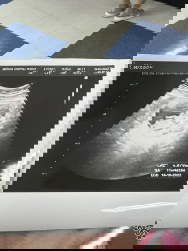 สอบถามแม่ๆ อายุ 30 ปีตรวจคัดกรองเด็กดาวน์กันมั้ยคะ?