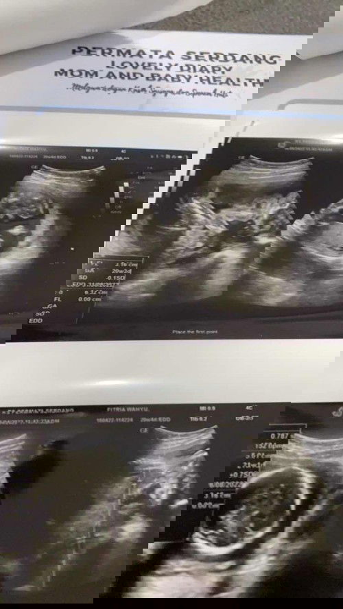 Hasil USG Janin 20 week