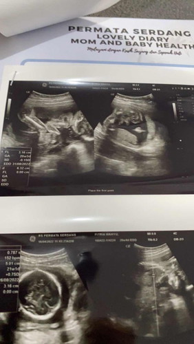 Hasil USG Janin 20 week