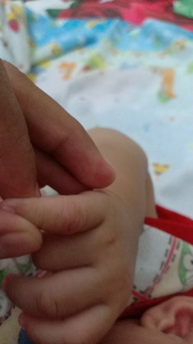 Kaki bayi beruntusan