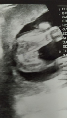 Scan 17w4d