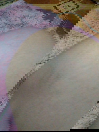 ใครมีขาแตกลายแบบนี้บ้างคะ