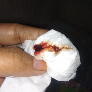 Solusinya Bun dari awal hamil sampai 7 Minggu Masi keluar darah takut janin kenapa2 c