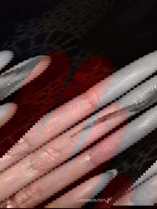 เลือดออกขณะตั้งครรภ์(ท้องสอง)