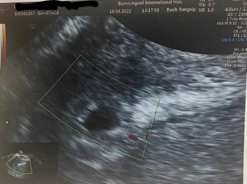 คุณแม่ท่านใดเคยซาวน์ทางช่องคลอดแล้วพบแต่ถุงบ้างคะ 7 weeks ค่ะ