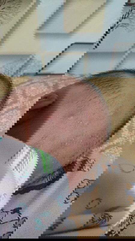 Bisul kecil banyak dikepala