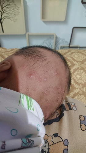 Bisul kecil banyak dikepala