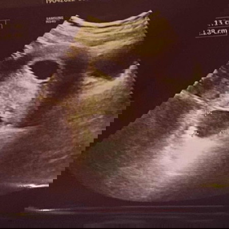 Pregnancy + cyst