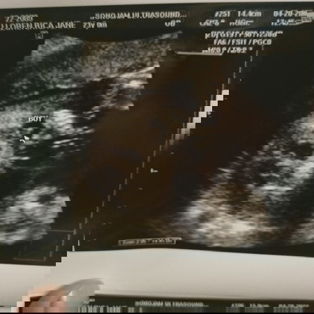 Ultrasound