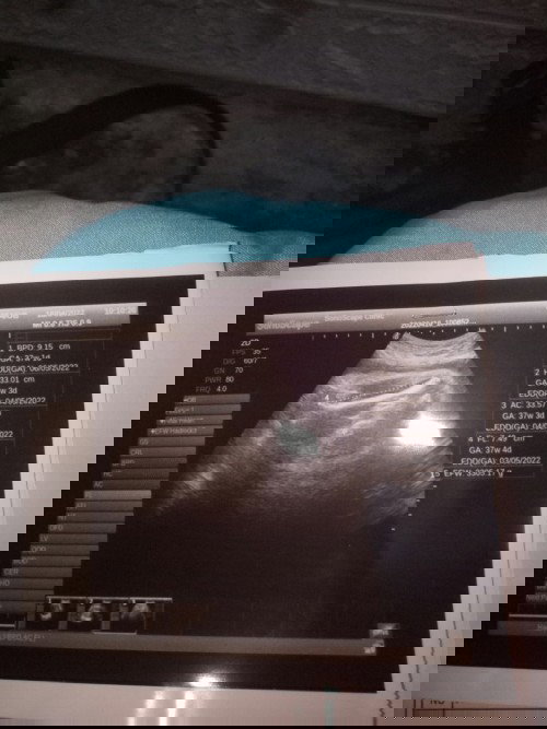 Nanya hasil usg usia kandungan 
37 minggu