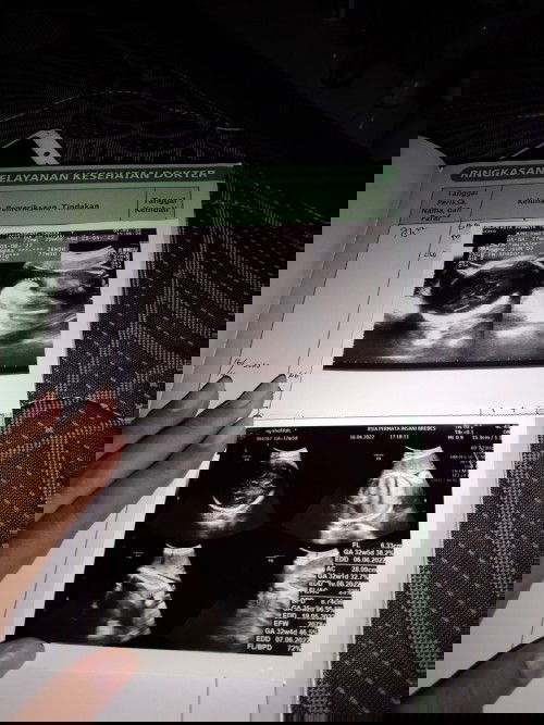 Hasil usg kehamilan 32week