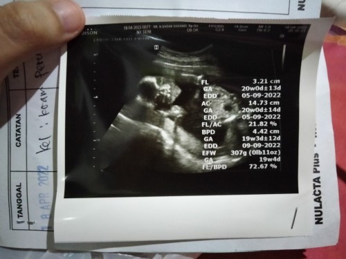 Apakah hasil USG usia 20 Minggu(5bulan) ini tolong artikan setiap apa itu FL dll? Apakah normal,,