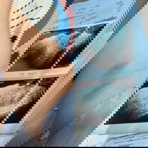 แท้ง ไม่พอถุงตั้งครรภ์