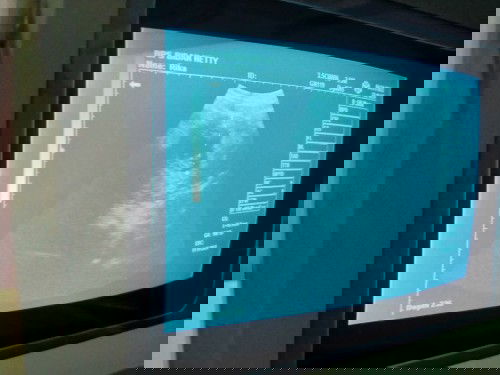 10w 1d apakah sudah ada detak jantung?